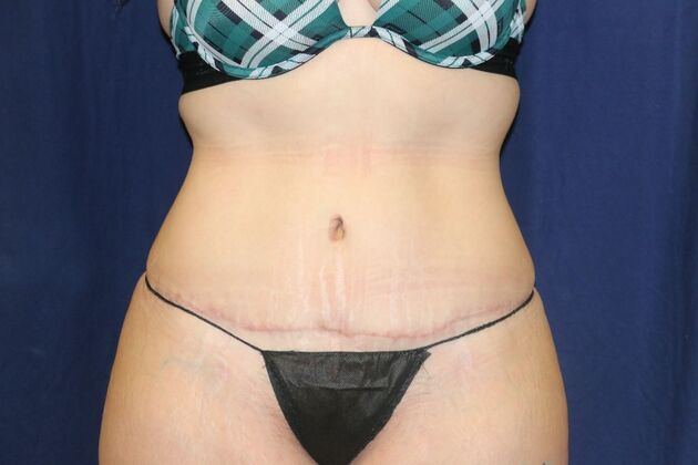 Tummy Tuck*: Case 2 - After