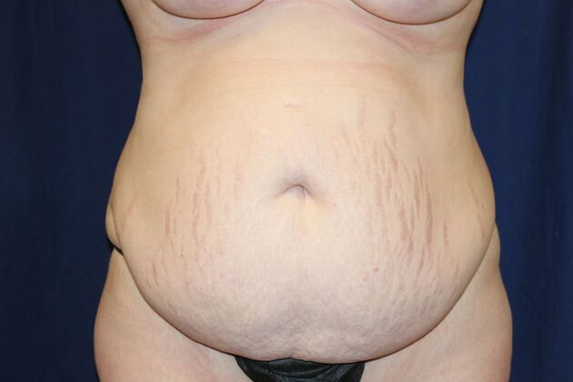 Tummy Tuck*: Case 3 - Before