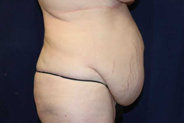 Tummy Tuck*: Case 3 - Before