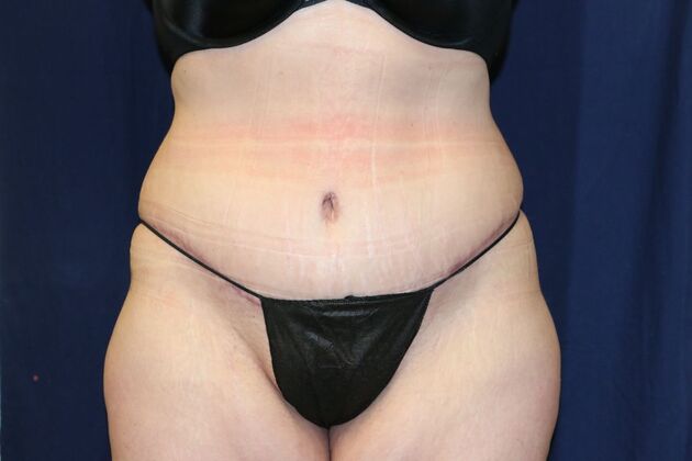 Tummy Tuck*: Case 3 - After