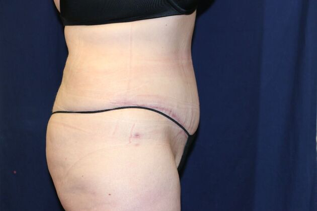 Tummy Tuck*: Case 3 - After