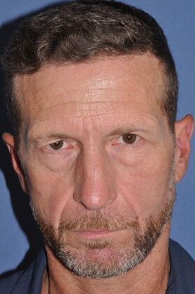 Endoscopic Browlift: Male Browlift and Upper Lids for Visual Field Issue - Before