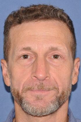 Endoscopic Browlift: Male Browlift and Upper Lids for Visual Field Issue - After