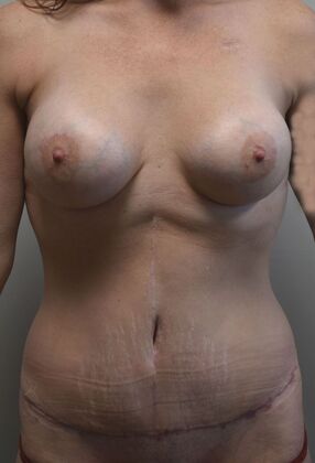 Mommy Makeover Case 242 - After