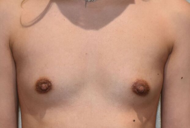 Breast Augmentation Case 710 - Before