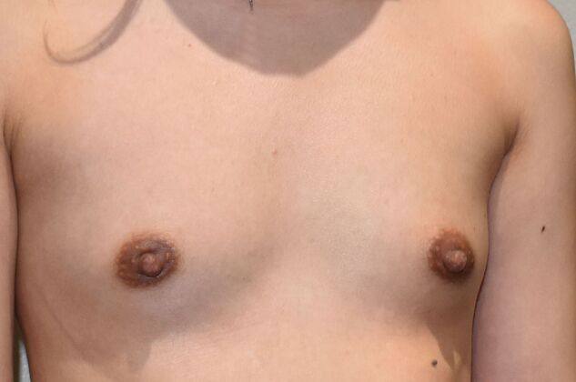 Breast Augmentation: Case 710 - Before