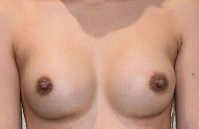 Breast Augmentation Case 710 - After
