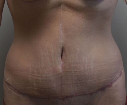 Tummy Tuck (Abdominoplasty): Case 373 - After