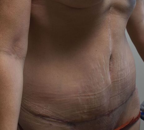 Tummy Tuck (Abdominoplasty): Case 373 - After