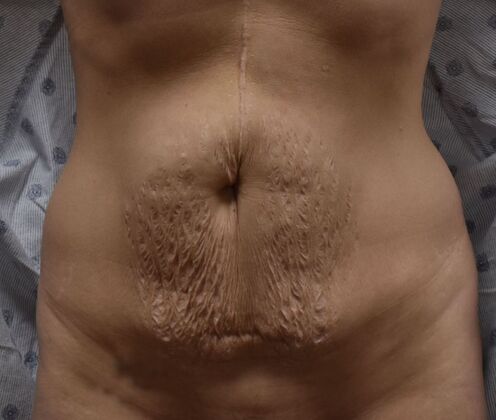 Tummy Tuck (Abdominoplasty): Case 373 - Before