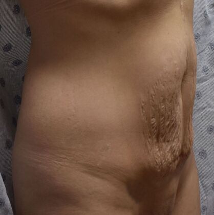 Tummy Tuck (Abdominoplasty): Case 373 - Before