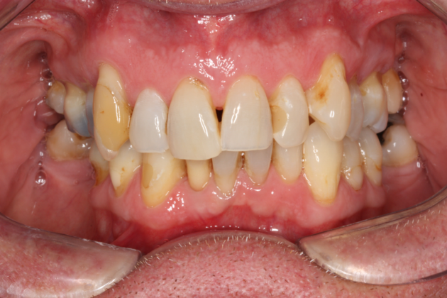 Porcelain Crowns and Veneers: Case 10 - Before