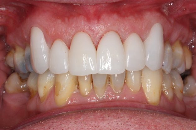 Porcelain Crowns and Veneers: Case 10 - After