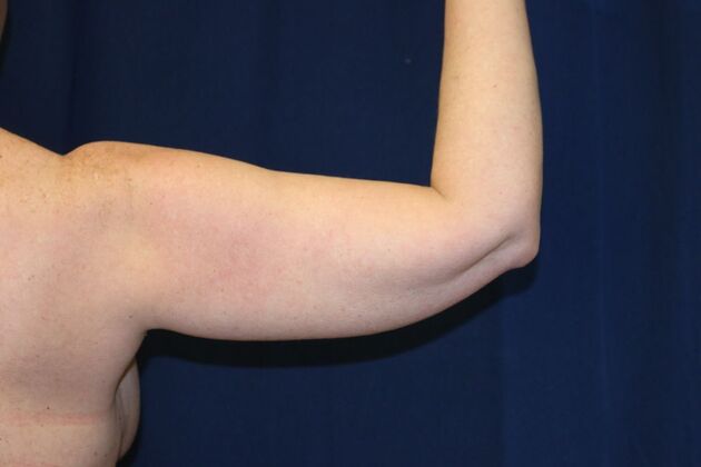 Arm Lift*/Arm Sculpting: Case 15 - Before