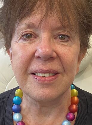 Facelift: Case 30 - Facelift, Norwalk, CT - After