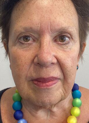 Facelift: Case 30 - Facelift, Norwalk, CT - Before