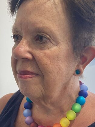 Facelift: Case 30 - Facelift, Norwalk, CT - Before