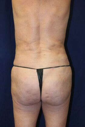 Brazilian Butt Lift : Case 14 - After