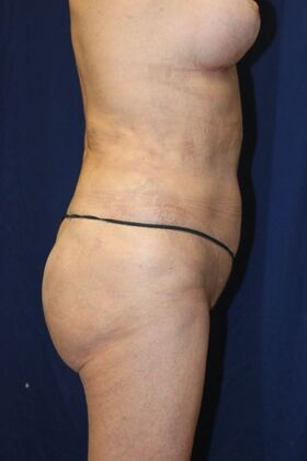 Brazilian Butt Lift : Case 14 - After