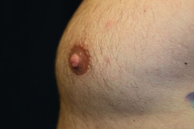 Male Breast Reduction*: Case 8 - After