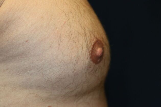 Male Breast Reduction*: Case 8 - After