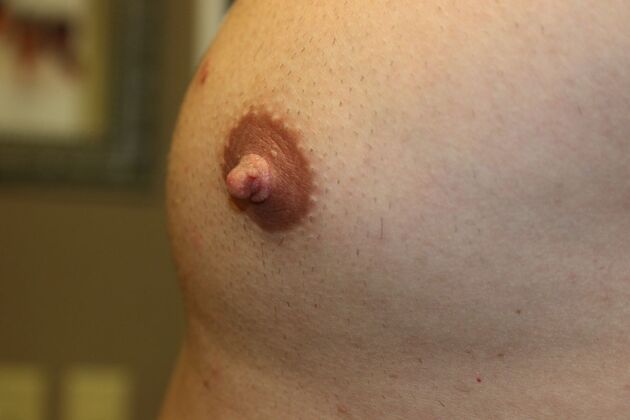 Male Breast Reduction*: Case 8 - Before