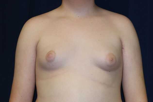 Male Breast Reduction*: Case 9 - Before
