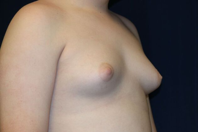 Male Breast Reduction*: Case 9 - Before
