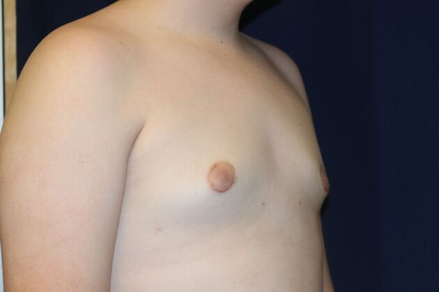 Male Breast Reduction*: Case 9 - After