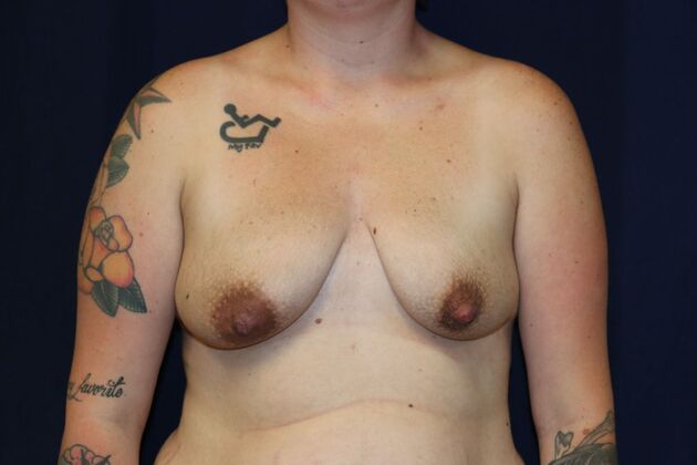 Breast Lift With Augmentation* Case 17 - Before