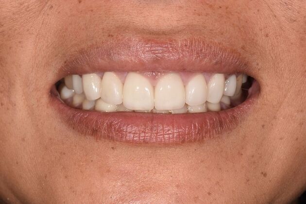 Smile Makeover: Case 46 - After