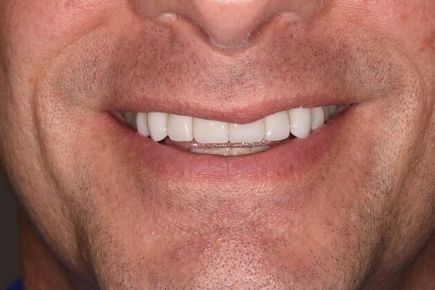 Smile Makeover: Case 48 - After