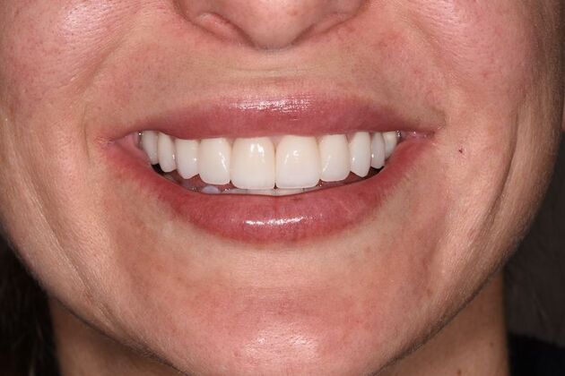 Smile Makeover: Case 49 - After