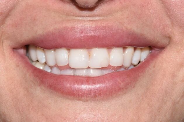 Smile Makeover: Case 49 - Before