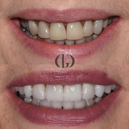 Smile Makeover Case 50