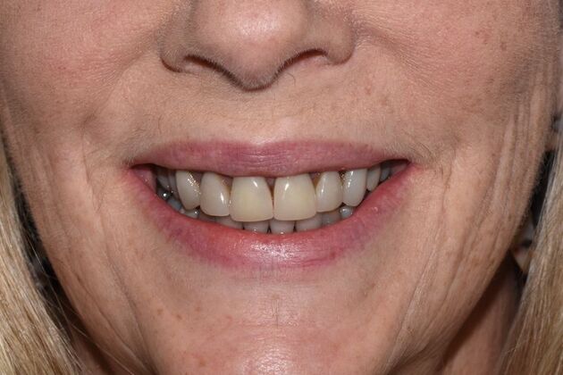 Smile Makeover: Case 50 - Before