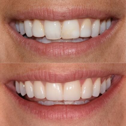 Smile Makeover Case 51