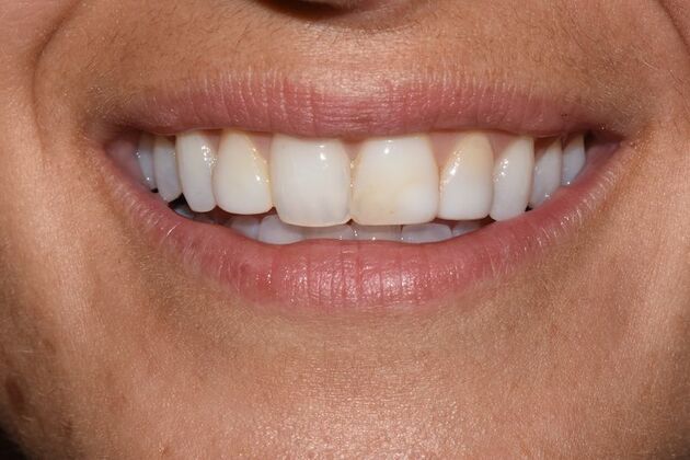 Smile Makeover: Case 51 - Before