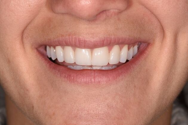 Smile Makeover: Case 51 - After