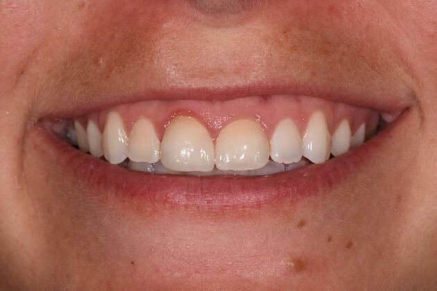 Case 53 Smile Makeover Before And After Gallery