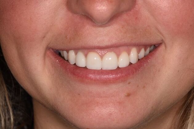 Smile Makeover: Case 53 - After
