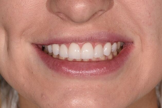 Smile Makeover: Case 54 - After