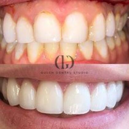 Smile Makeover: Case 6 - Before & After