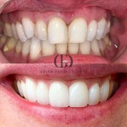 Smile Makeover: Case 8 - Before & After