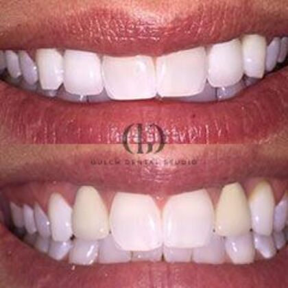 Smile Makeover: Case 2 - Before & After