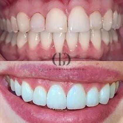Smile Makeover: Case 7 - Before & After