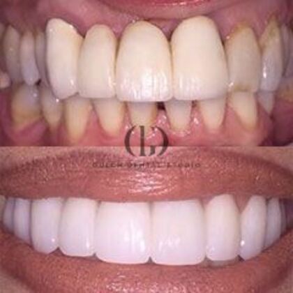 Smile Makeover Case 3