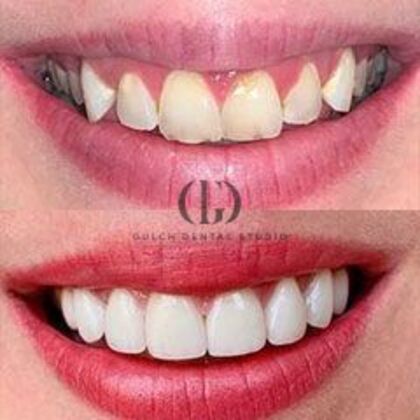 Smile Makeover: Case 9 - Before & After