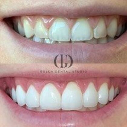 Smile Makeover: Case 55