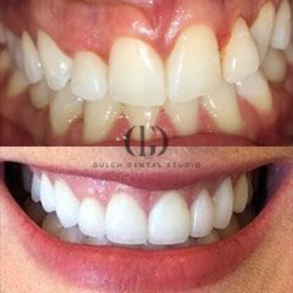 Smile Makeover: Case 56